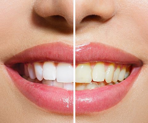 Before and After Whitening