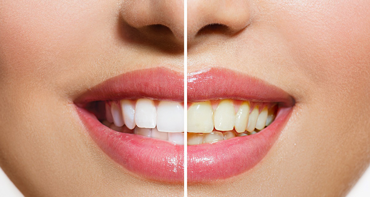 Before and After Whitening