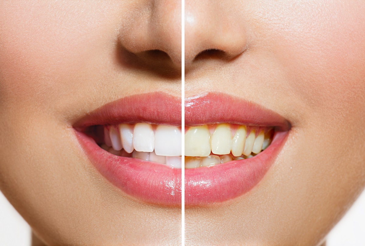 Before and After Whitening