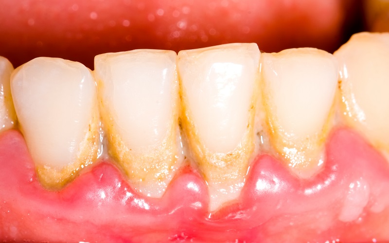 Dental tartar (a result of a build up of plaque)