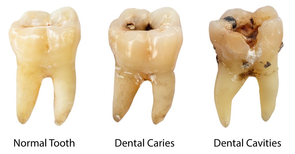 Various stages of tooth decay