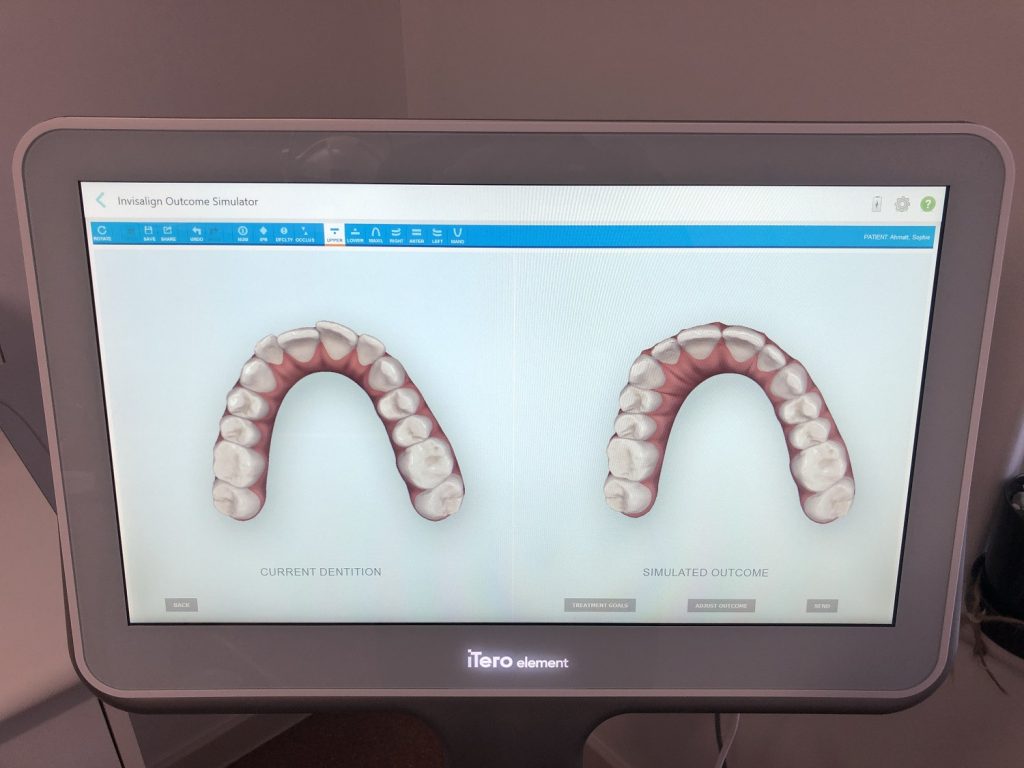 Invisalign Scan