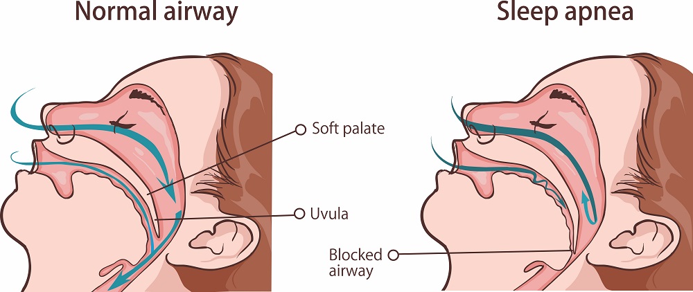 How sleep apnea occurs