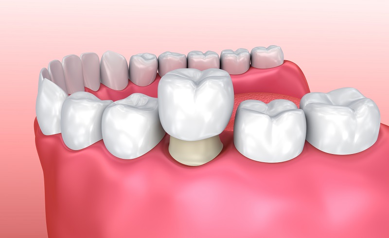 Dental crown installation process