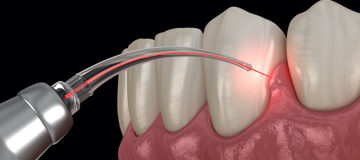 Laser Dentistry