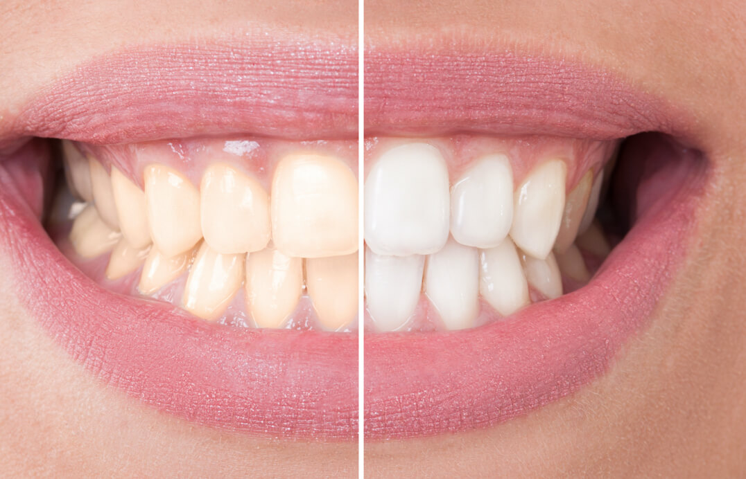 The real colour of newly whitened teeth typically reveals itself in a couple of days.