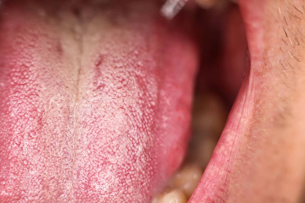 what does a healthy tongue look like