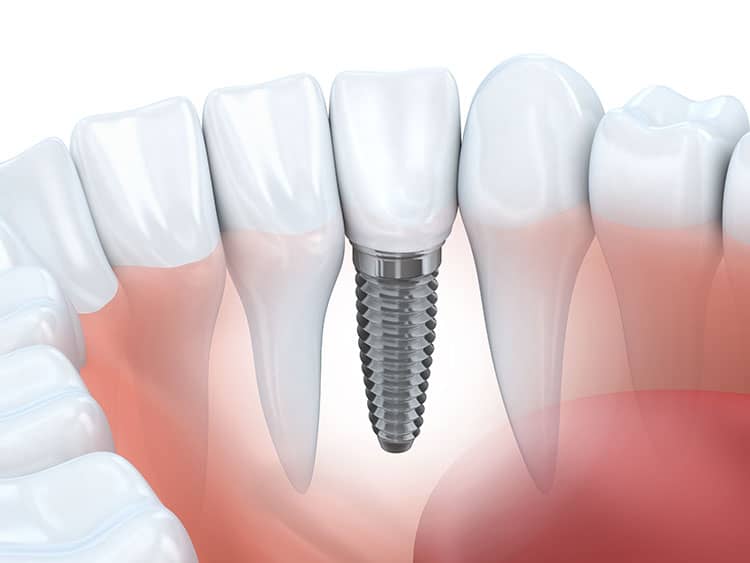 Dental implant illustration