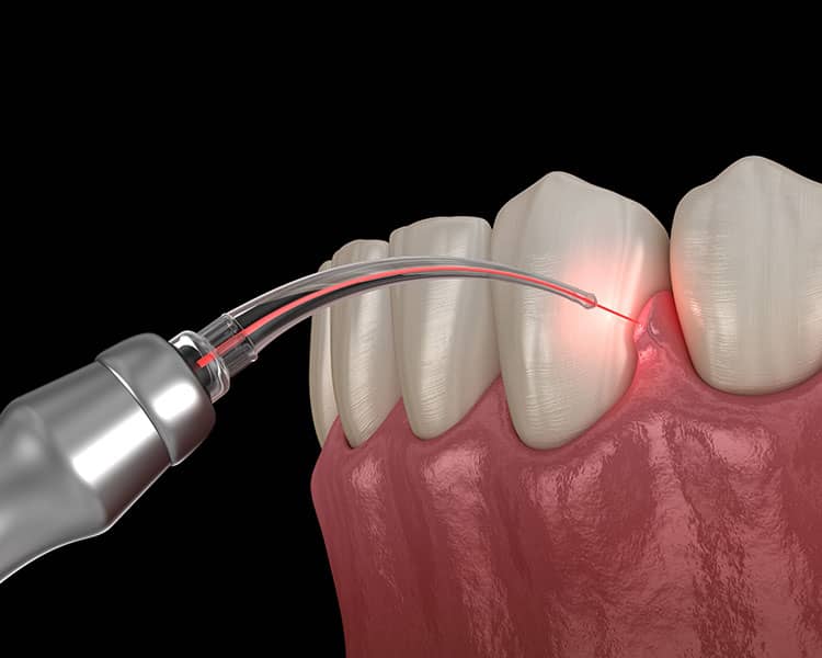 Laser dentistry example