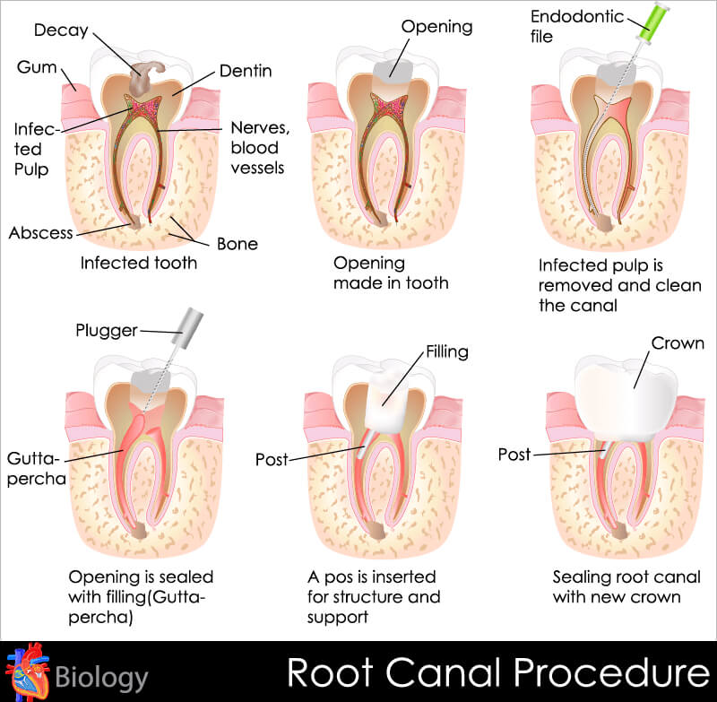 Root canal treatment explained