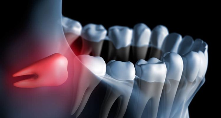 wisdom tooth illustration