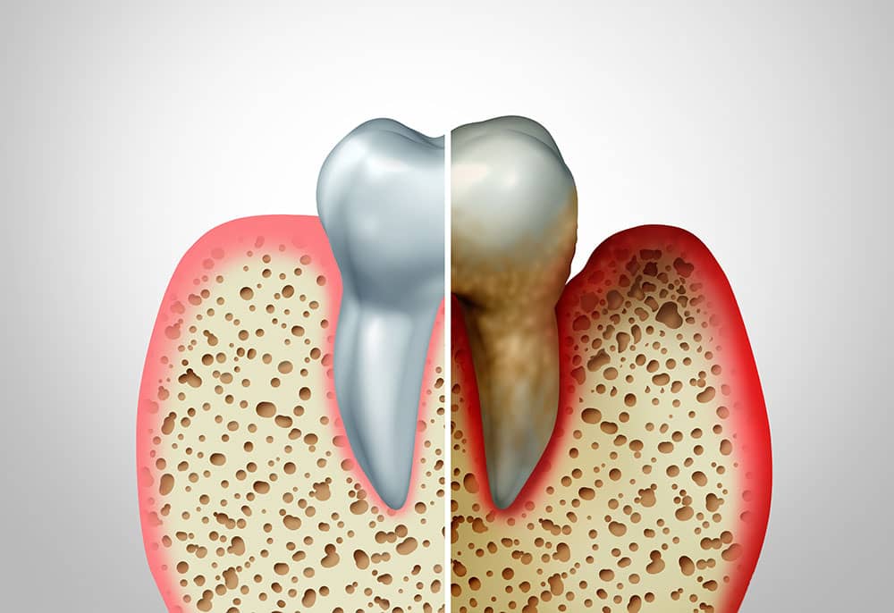 comparison between health and diseased gum