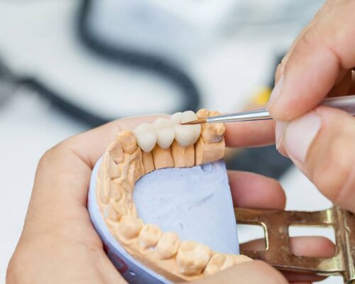 dentist creating dental bridge dentist creating dental bridge
