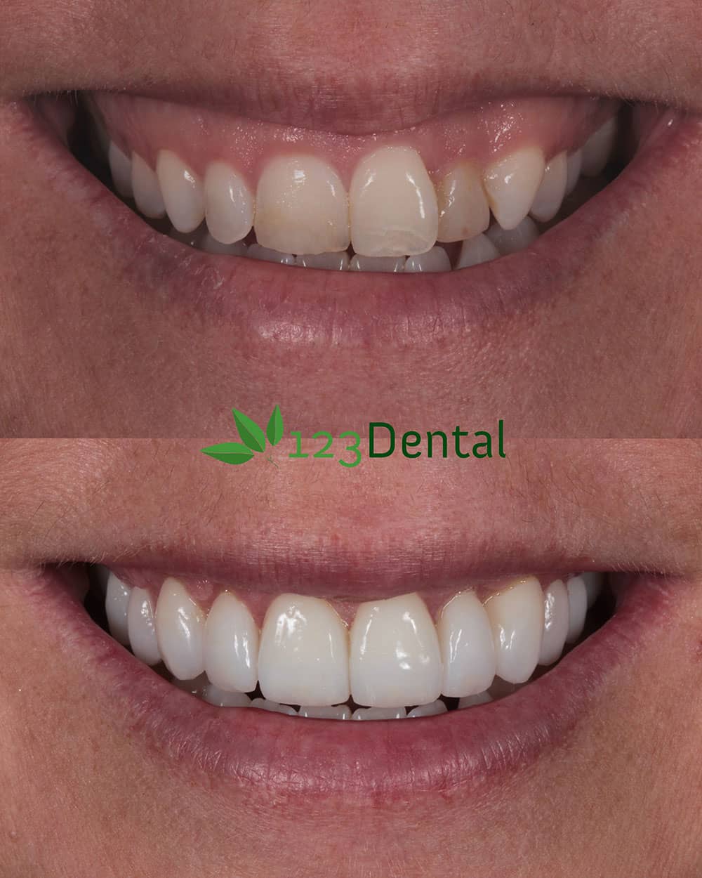 before and after veneers
