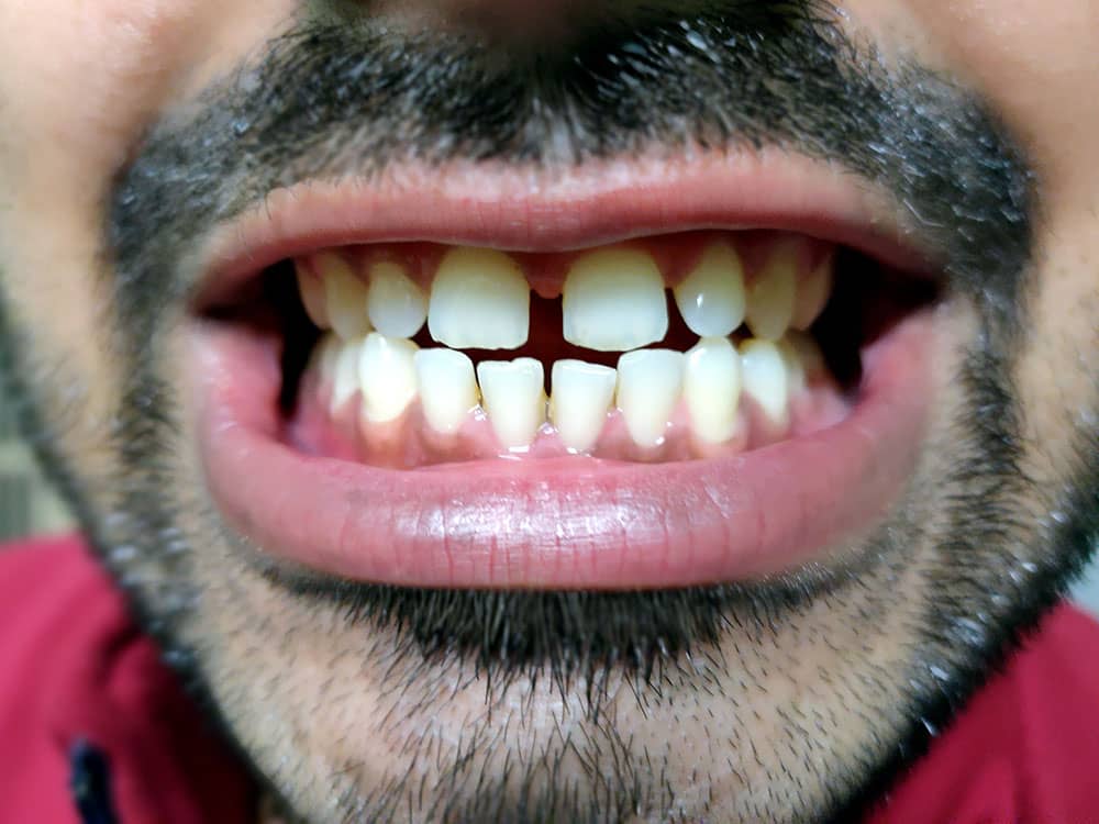 male teeth gaps