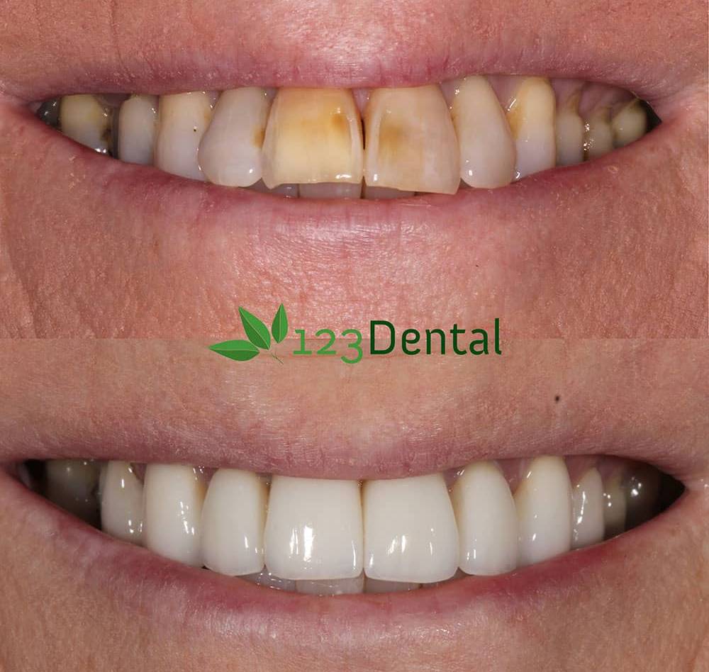 123dental crowns treatment