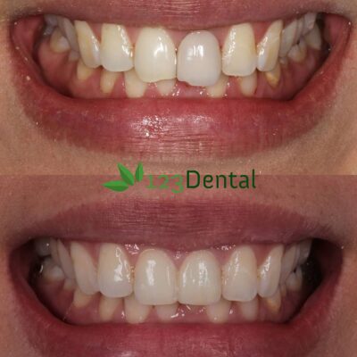 patient with happy smile after crowns