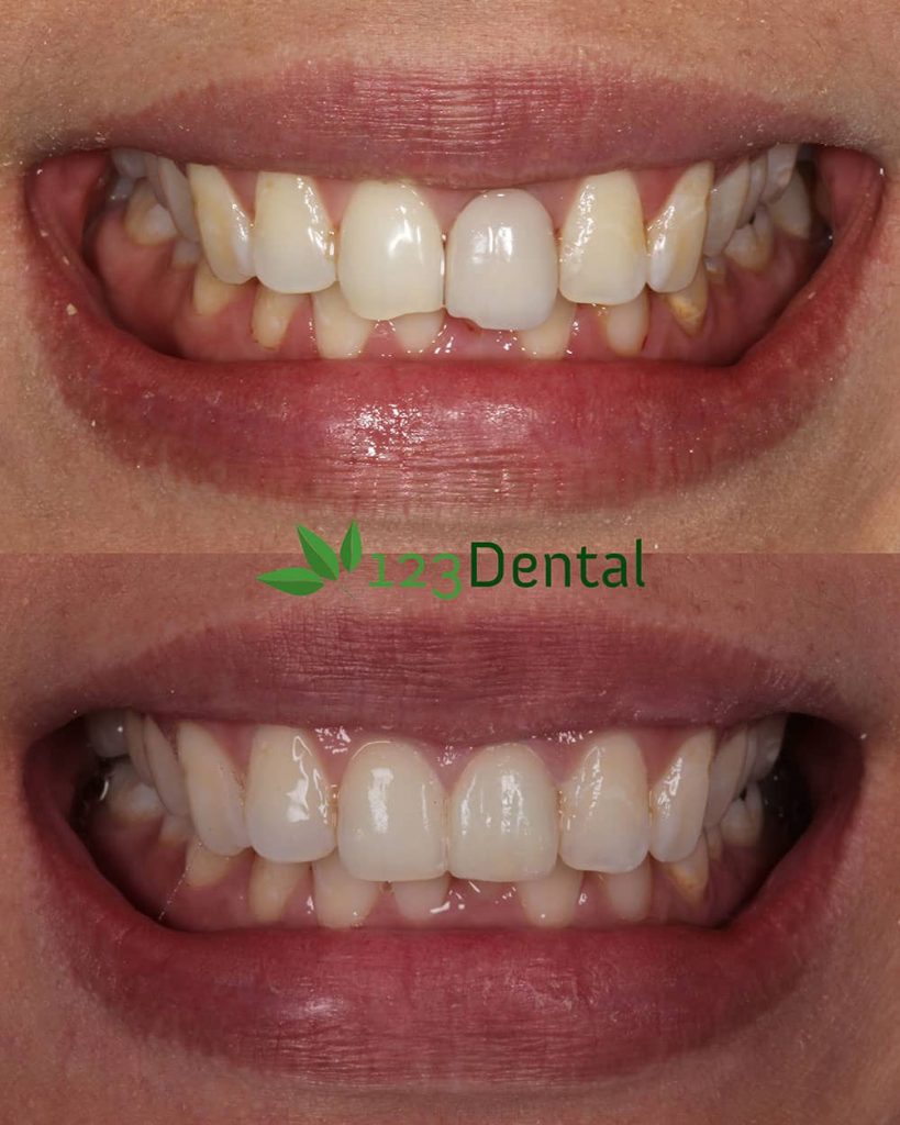 patient with happy smile after crowns