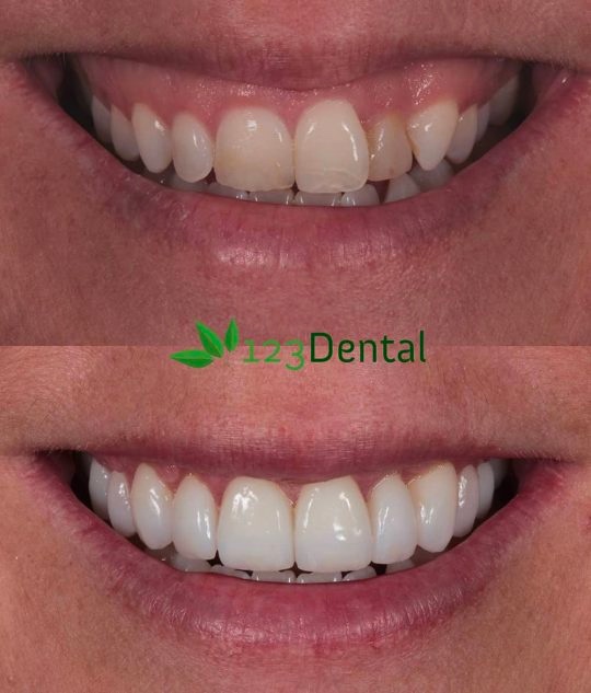 porcelain veneers before and after 123 Dental