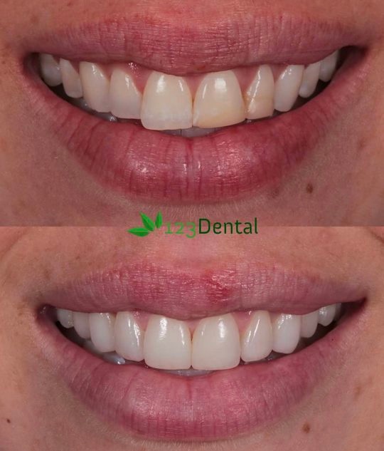 porcelain veneers before and after 123 Dental