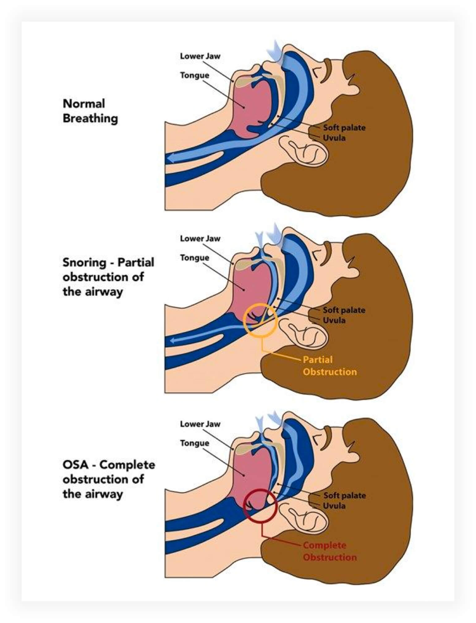 snoring diagram image