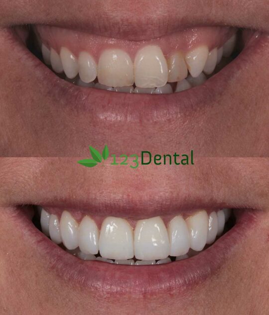 perth veneers service before and after