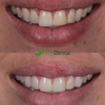 new teeth, veneers before and after