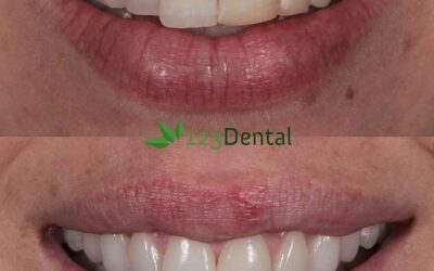 new teeth, veneers before and after