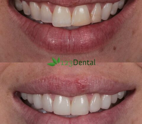 new teeth, veneers before and after