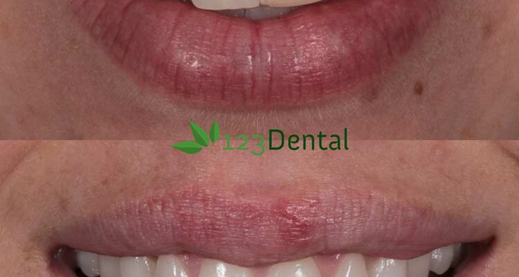 new teeth, veneers before and after