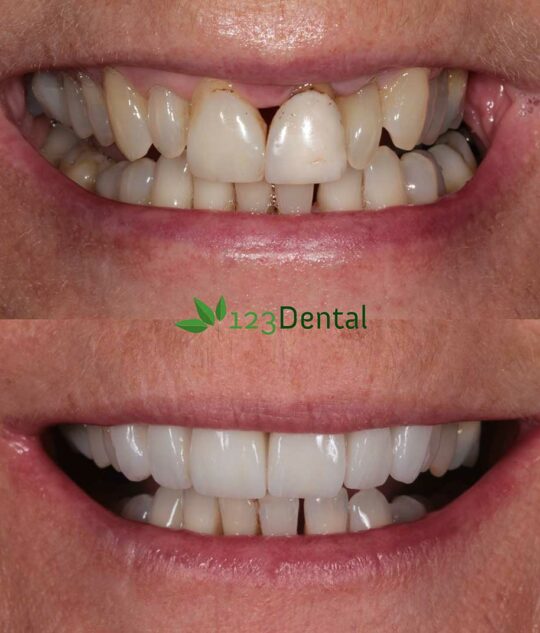 veneers before and after