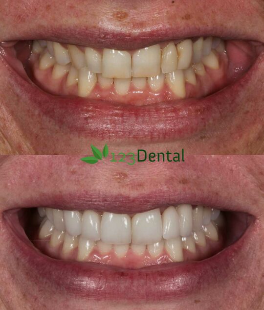 veneers transformation before and after