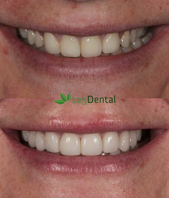 before and after porcelain veneer