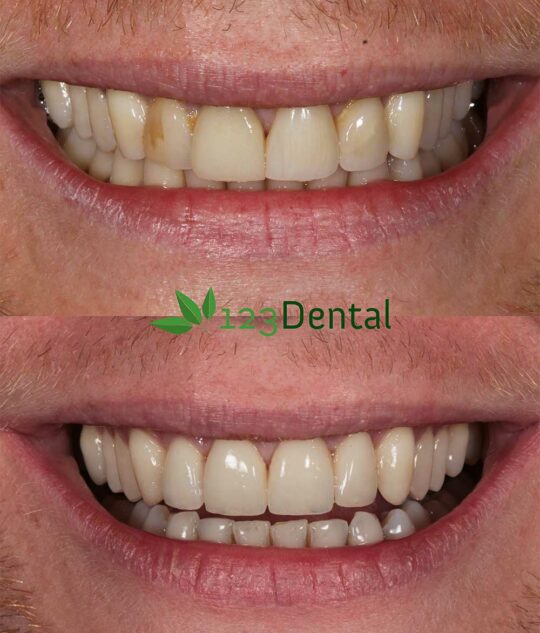 veneer treatment perth