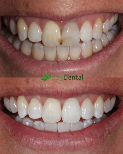 Teeth Whitening In Perth