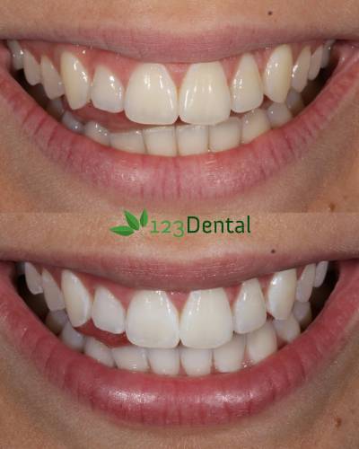 teeth whitening perth, before and after