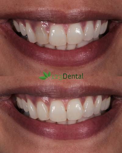 Great Teeth Whitening Results