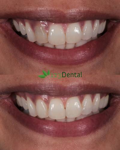 before and after teeth whitening in perth with 123 dental