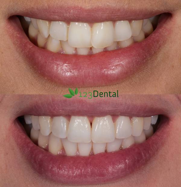 before and after invisalign