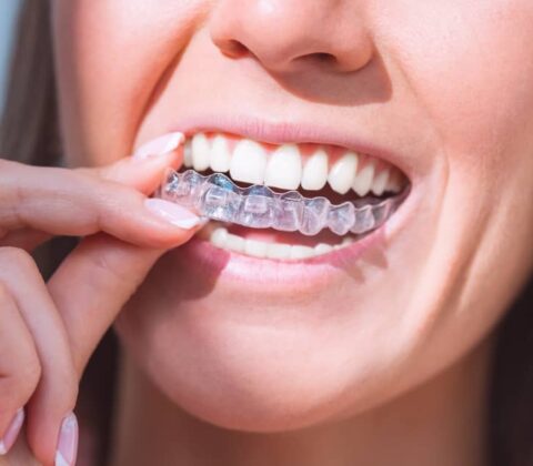 Aftercare is important for all orthodontic treatments, including Invisalign.