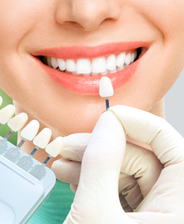 comparing teeth to veneers for correct colour match