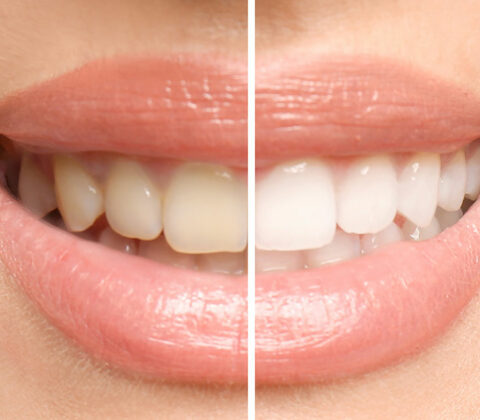 teeth whitening before and after comparison