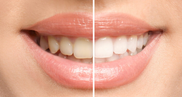 teeth whitening before and after comparison