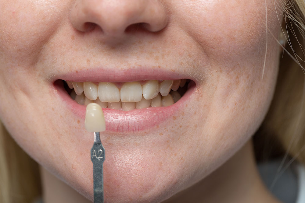 lady holding dental veener example