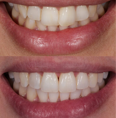 before-after-1 before and after shot of dental crown