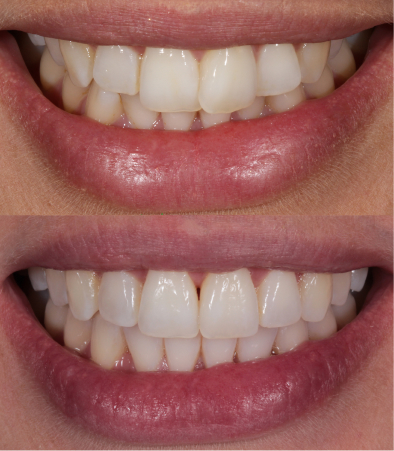 before and after shot of dental crown