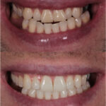 teeth before and after dental crown