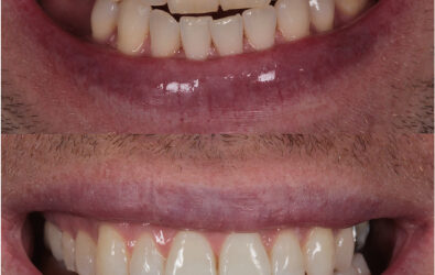 teeth before and after dental crown
