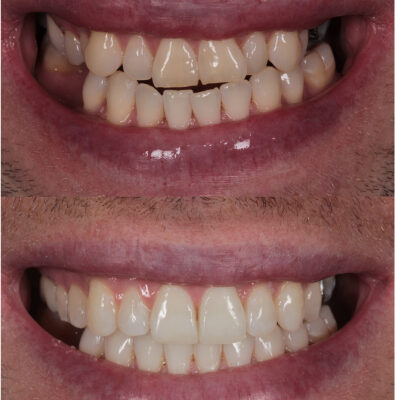 teeth before and after dental crown