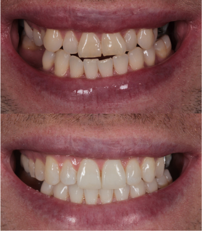 teeth before and after dental crown
